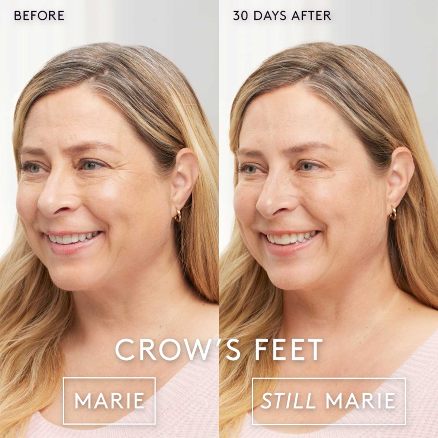 Botox Reston Wrinkle Reduction AustinWeston